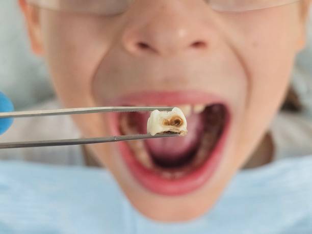 Best Emergency Tooth Extraction in Charenton, LA